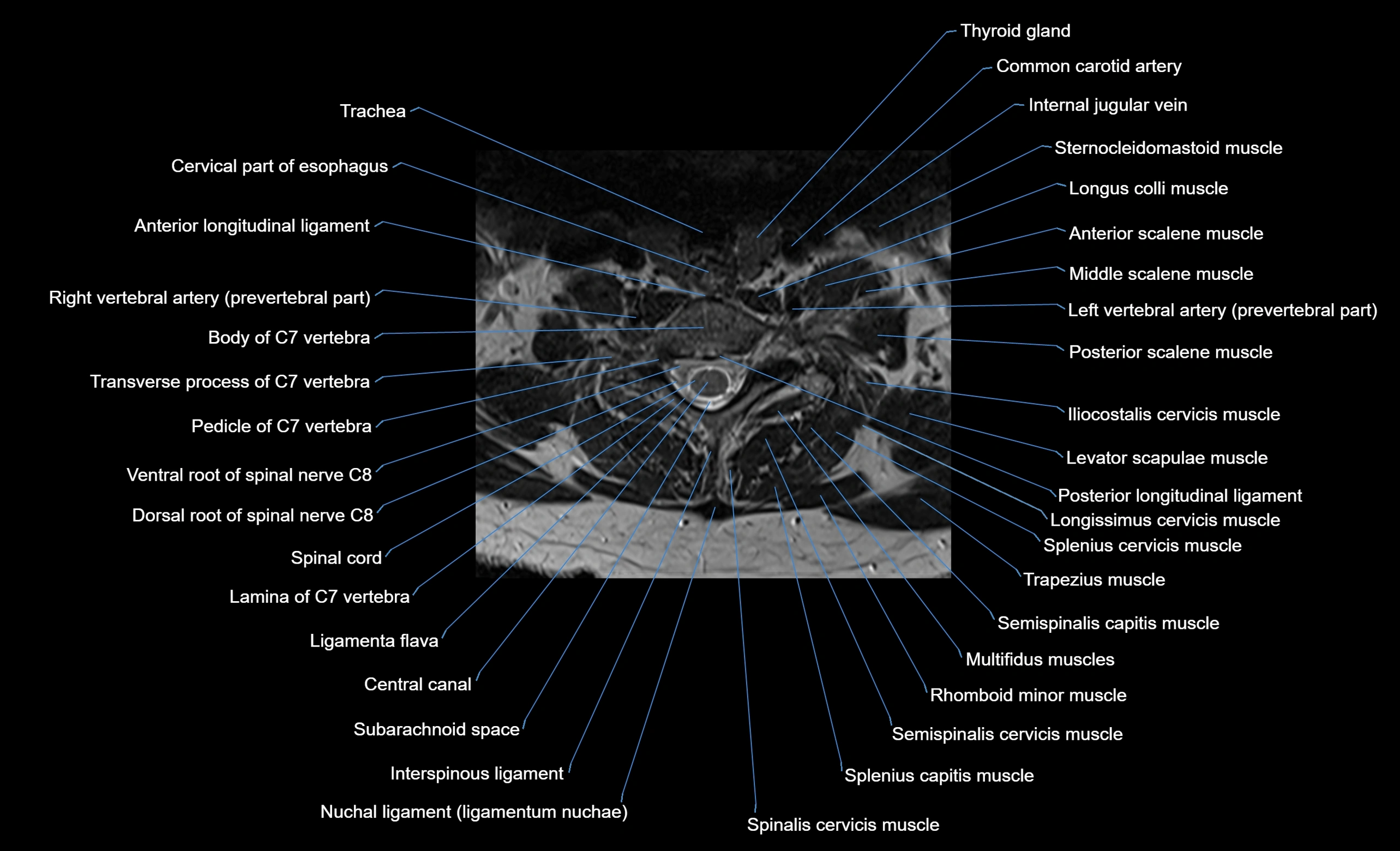 cervical spine cross sectional MRI anatomy  3T MRI axial  image-img-00001-00036.webp